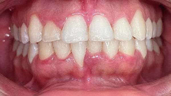Después del tratamiento Invisalign: sonrisa amplia y dientes nivelados
